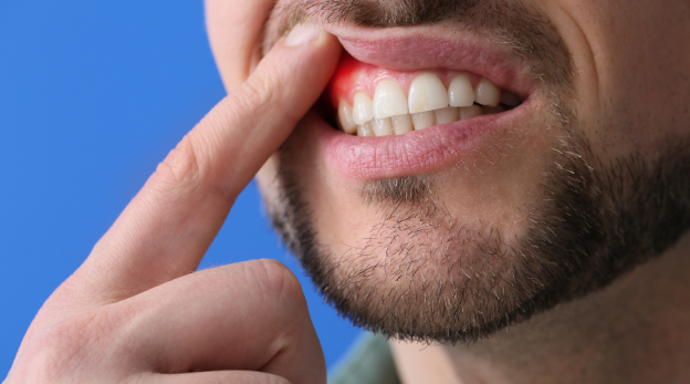 Bleeding Gums: When to Worry and What to Do for Immediate Relief 