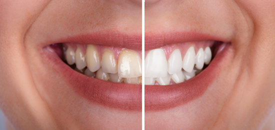 Everything You Need to Know About Teeth Whitening Sensitivity and Prevention